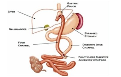 胃繞道減重手術