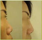 微晶瓷玻尿酸隆鼻效果前后對比